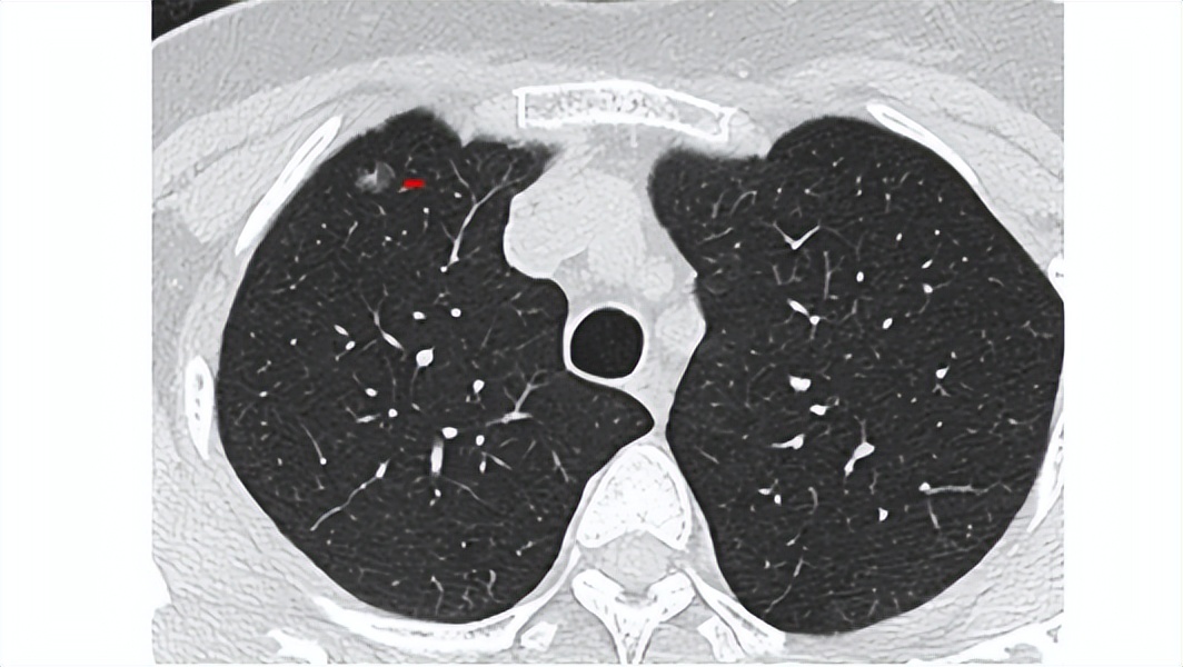 微浸润肺腺癌影响寿命吗？
