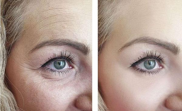 当有眼袋后，会比同龄人显老，掌握5个方法，或许能去除眼袋