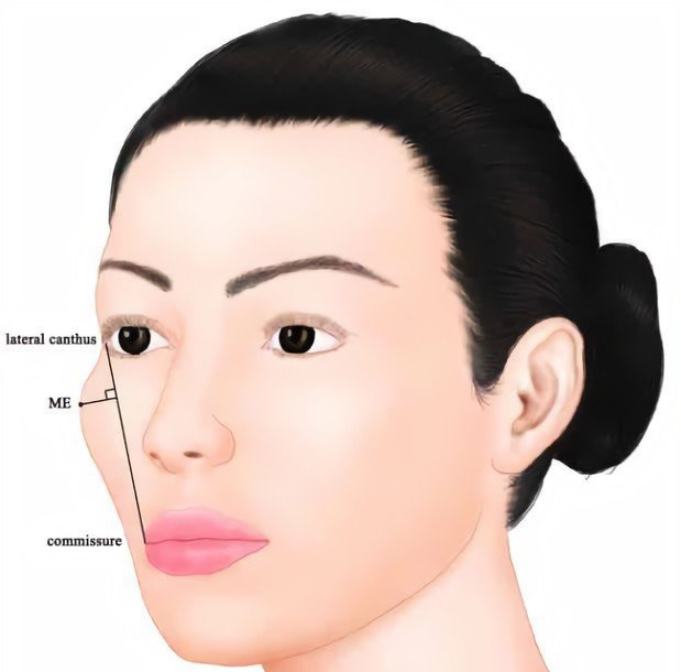 不同的颧骨形态类型，哪些需要改善
