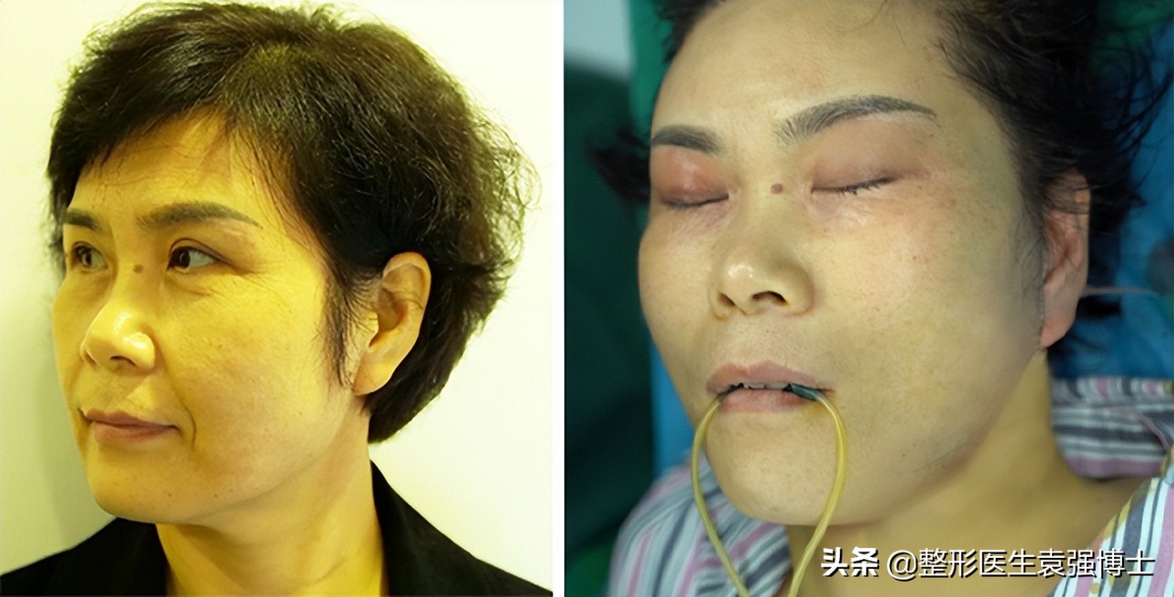 想摆脱“法令纹”，医生揭秘几点真相，一般人不会说
