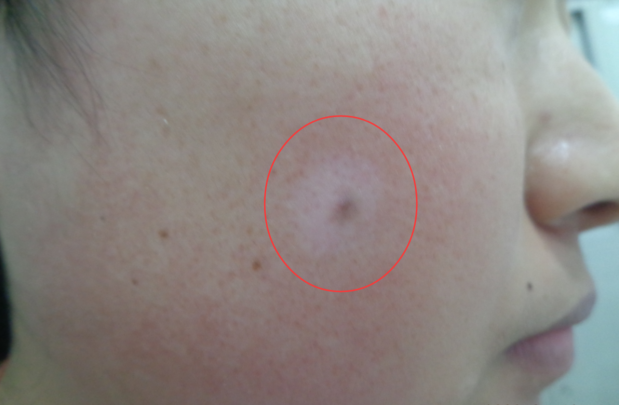 晕痣型白癜风怎么治疗?白癜风专家一文讲述清楚