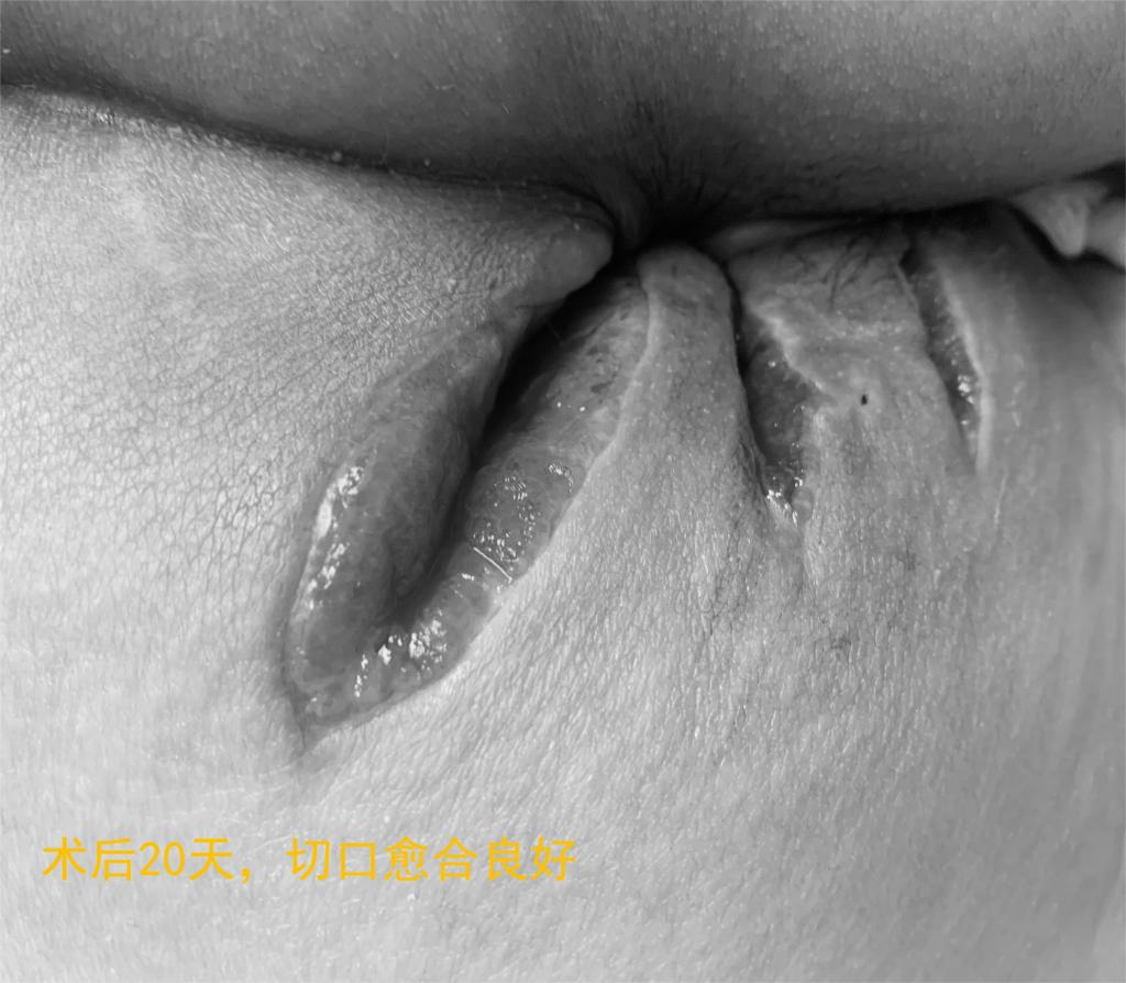 仁医科普| 菊花疼不一定是痔疮，警惕肛周脓肿！