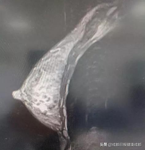 吓趴了！乳房胀痛甚至有硬物是不是得了乳腺癌？