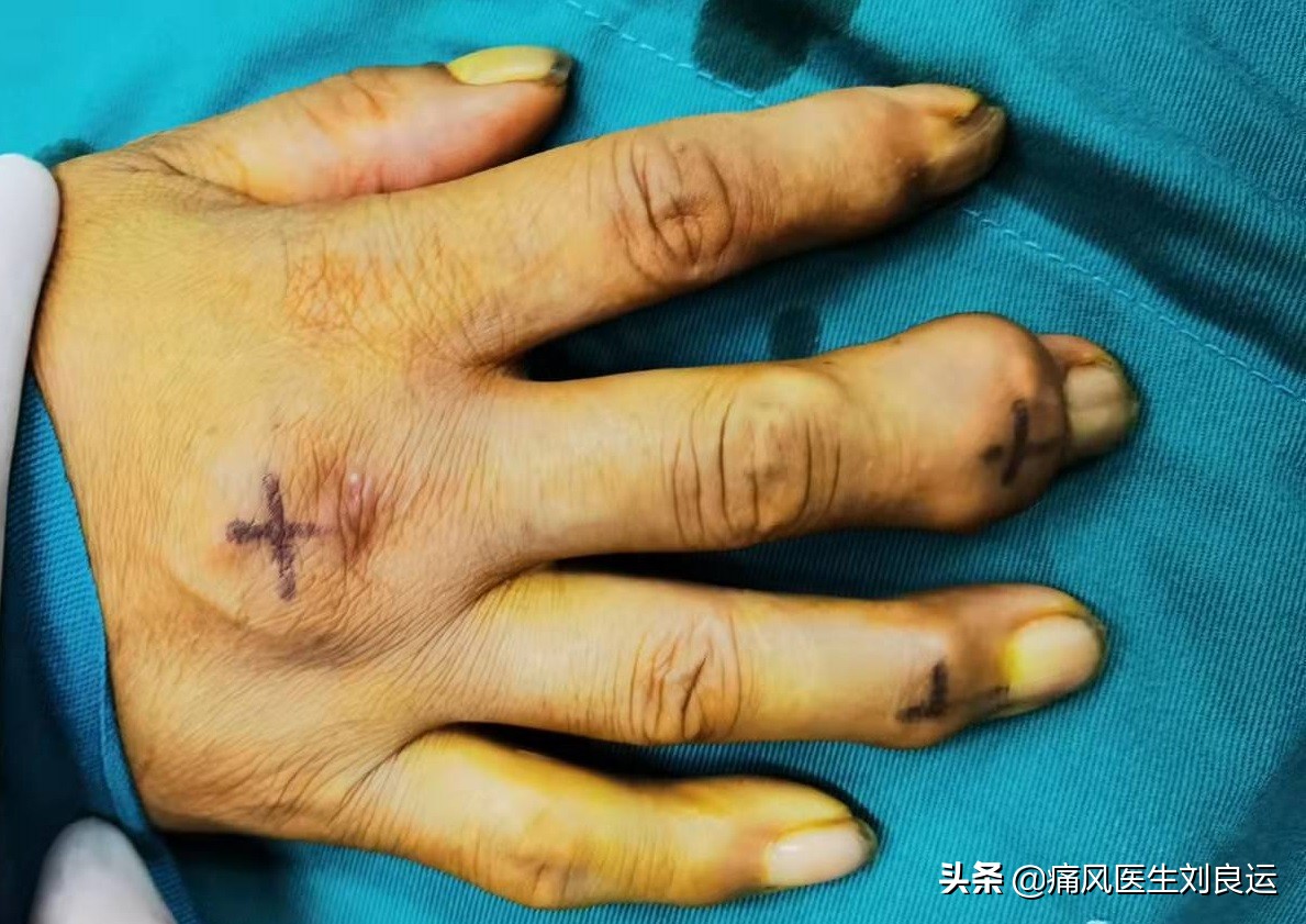 发现自己尿酸高或有痛风后，您是不是第一时间找找自己是不是吃错什么或吃多什么？不少