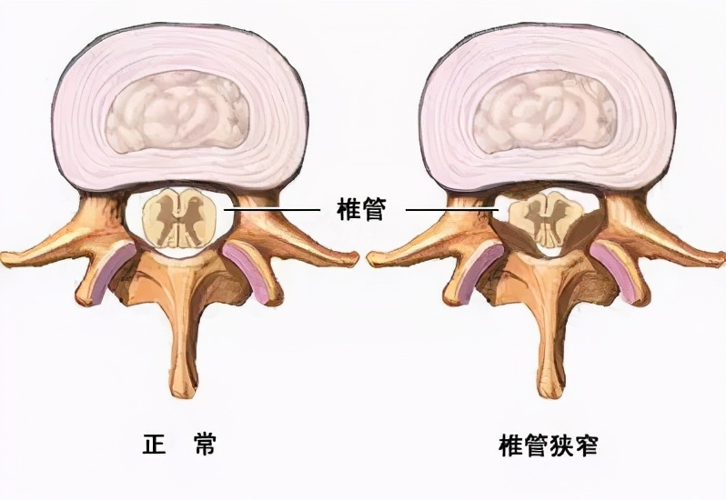 大部分腰椎间盘突出症不用手术？可以用这3类药，做好预防更重要