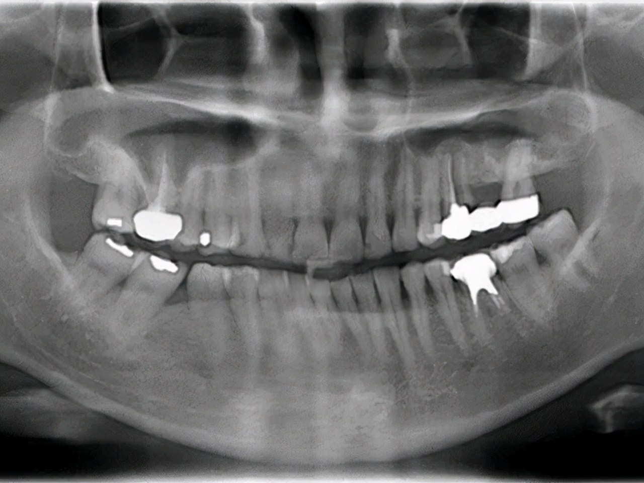 牙齿松了如何恢复？这5招简单又有效！专家：早知早受益