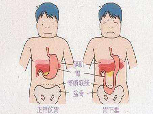 经常腹胀可能是胃下垂，不注意还会使肝脏下垂！中医一招教你治疗