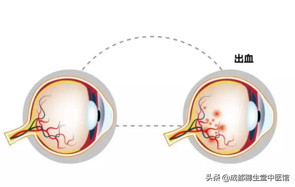 眼底出血怎么快速消除(外伤眼底出血怎么快速消除)