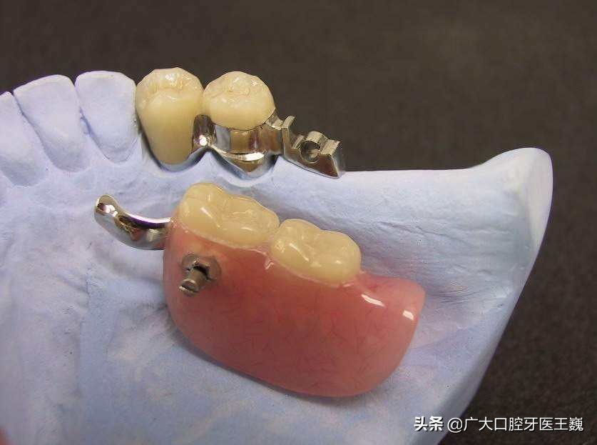 缺牙别再戴挂钩假牙了，新型无挂钩义齿不伤健康牙