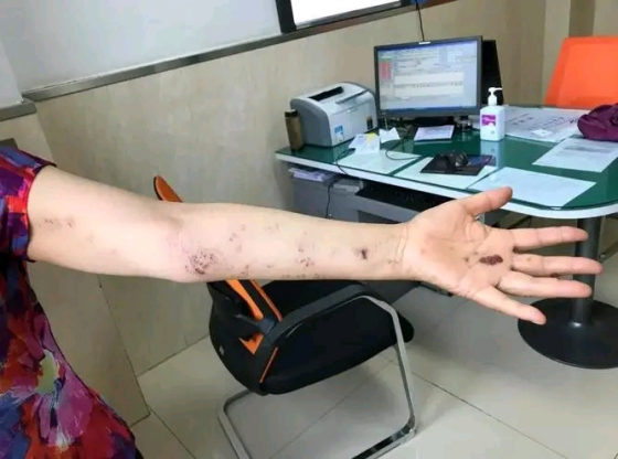 五,带状疱疹疾病的治疗手段