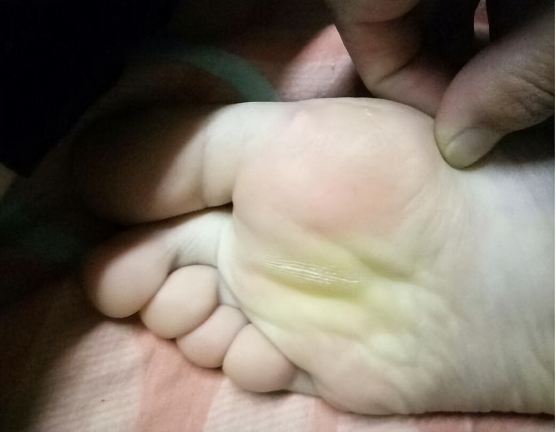 走路前脚掌痛怎么回事(脚底板爱生茧子) - seo葵花宝典