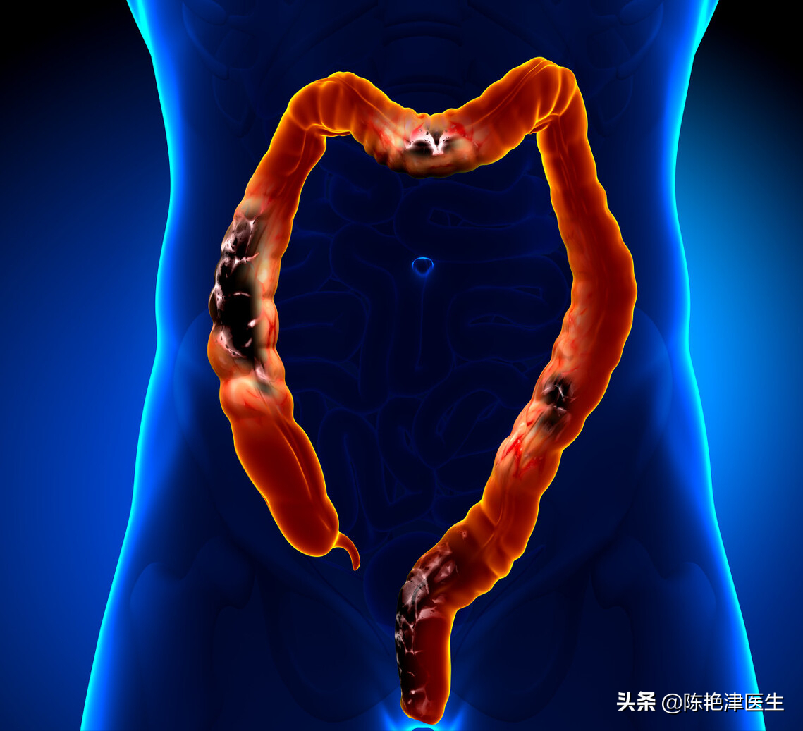 肠息肉是肠癌最大的祸根，如何不让息肉再生长？3件事要做好