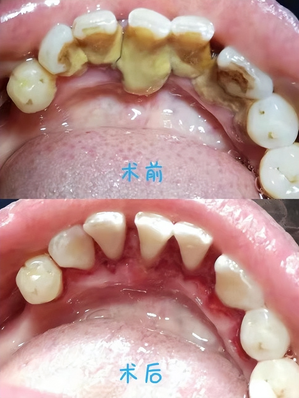 什么是牙周病？危害有这些