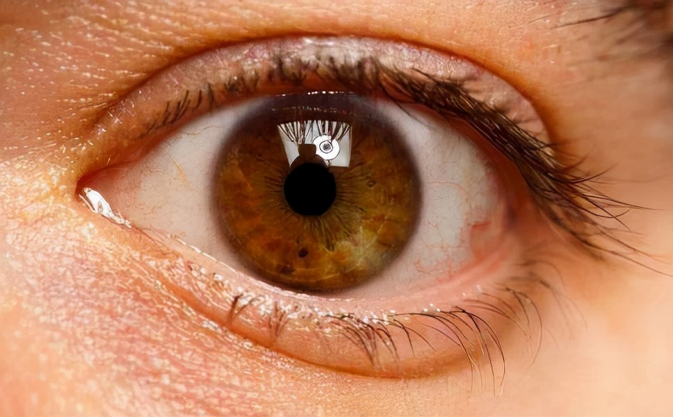 眼睛黄斑图片(") - 赤虎壹号