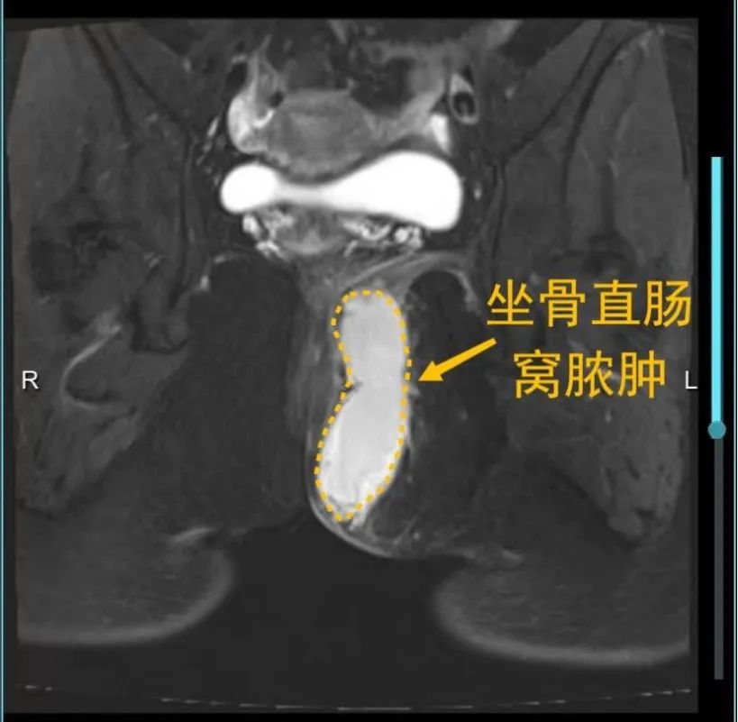 仁医科普| 菊花疼不一定是痔疮，警惕肛周脓肿！