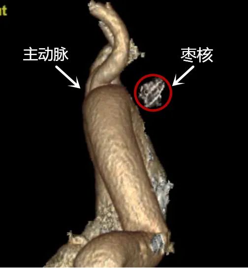 「健康科普」市中心医院消化内科：“致命”枣核，警惕食管异物