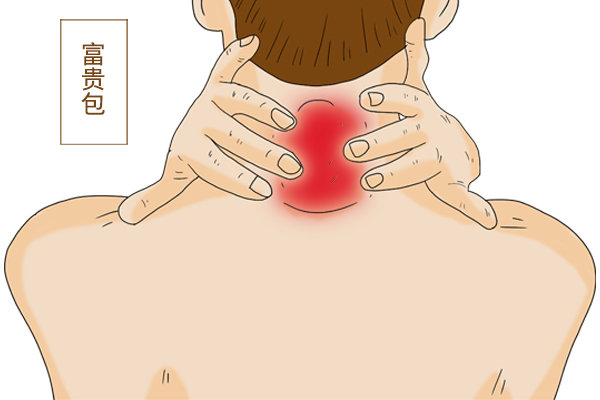 “富贵包”不富贵，反而会招致疾病，如何治疗富贵包？教你好方法