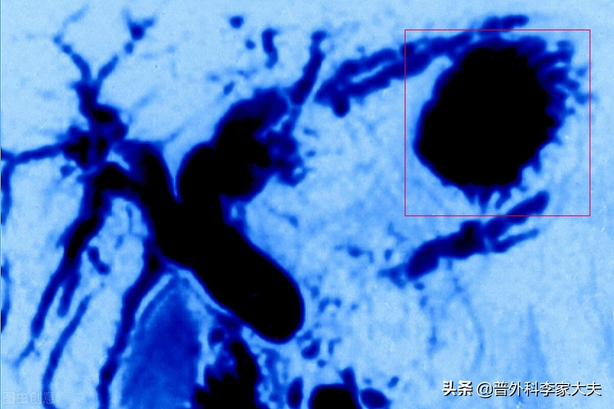 既然胰腺癌这么可怕，那能不能在高发年龄段就将它割掉？