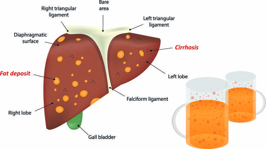 喜欢喝酒的人，身体有7个“异常”，酒精肝或许来报道了，需重视