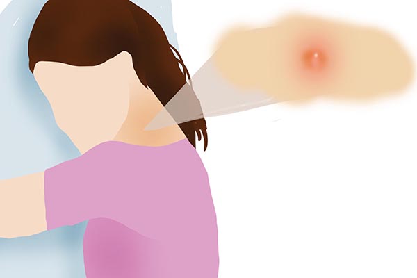 脖子腋下长出“小肉粒”，警惕HPV感染！抠掉行不行？听医生说