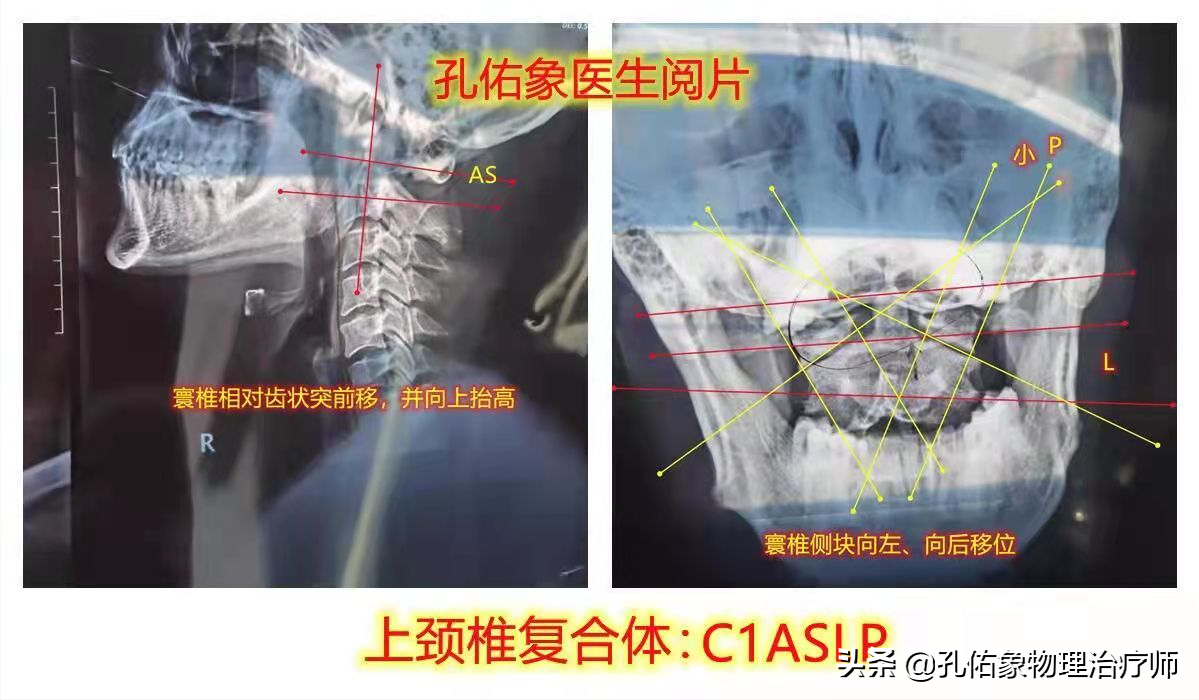 手指麻、肩胛骨疼痛，是怎么回事？出现这4个症状是颈椎发出信号