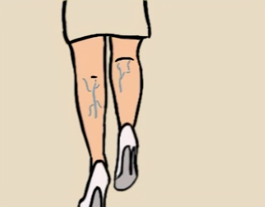 静脉曲张的症状，静脉曲张吃什么食物好？