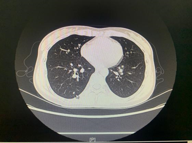 34岁女子体检发现的肺结节竟然是肺腺癌！微创手术治愈