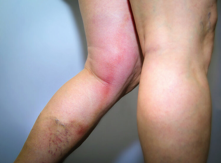 有的人手臂“青筋暴起”，有的人几乎看不见青筋，哪种人更健康？