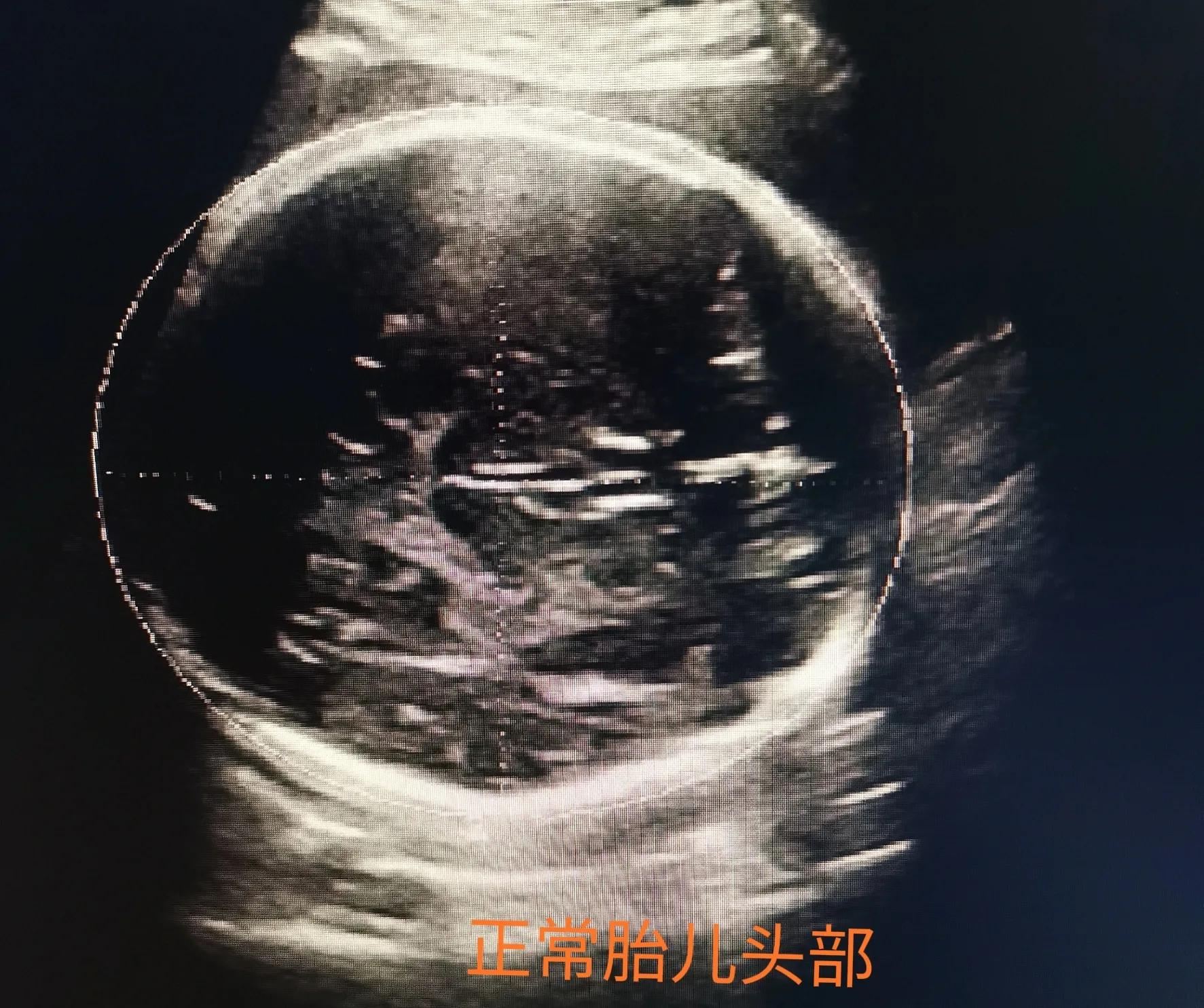 胎儿的自救：因怀疑畸形差点被引产，早产后发现有畸形的却是孕妇