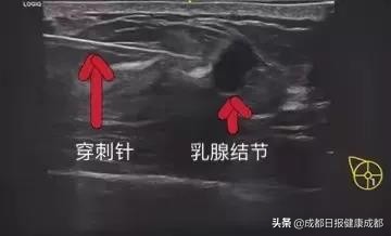 吓趴了！乳房胀痛甚至有硬物是不是得了乳腺癌？