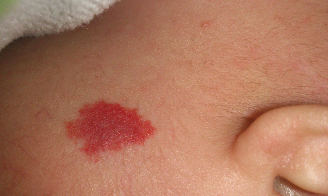 「家长注意」别把婴幼儿身上的血管瘤当胎记!3招让你快速鉴别