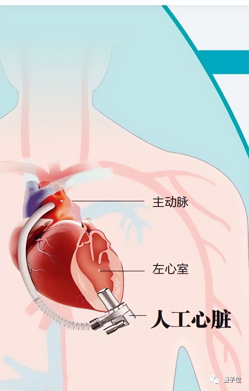 全球最小人工心脏在华中科大完成植入：58岁患者术后精神状态良好