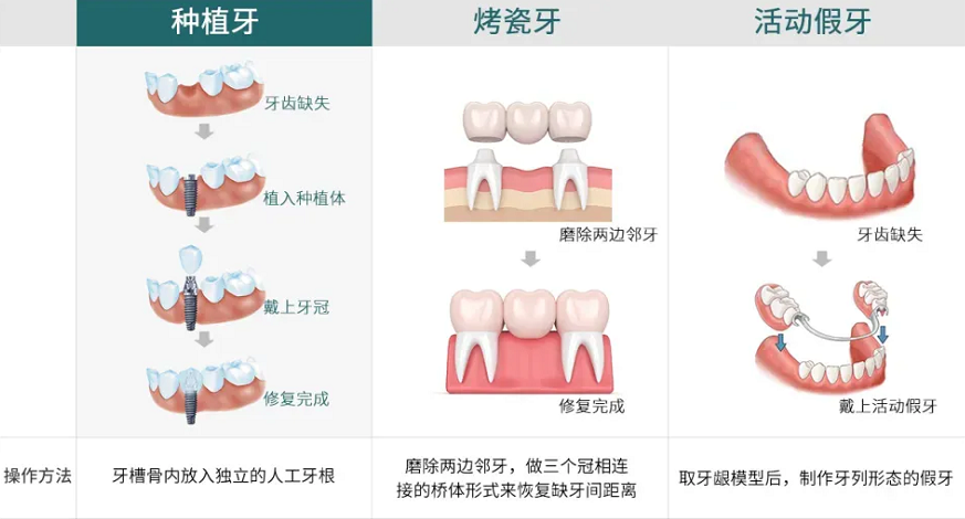 1,镶牙方式的选择牙齿缺损,常见的修复方式有三种:固定修复,活动假牙