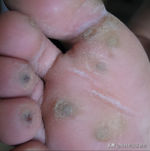 引起的主要长在脚底皮肤的一个硬物顶压和刺激,引起点状的小角质增生