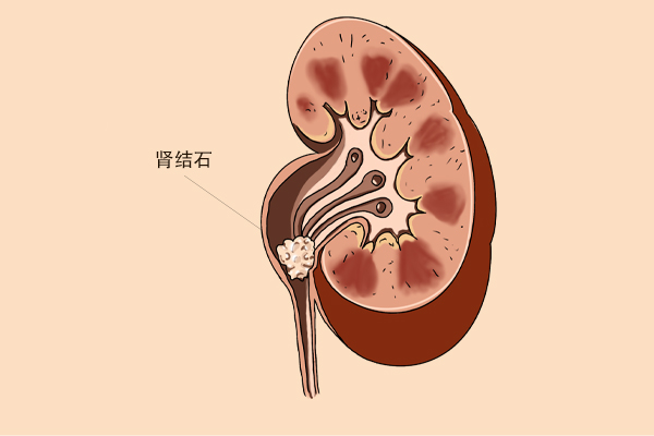 長期吃3種藥可能會誘發痛風，如果你正在吃，建議調整方案