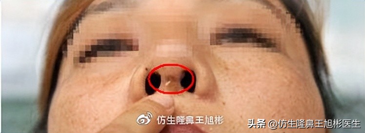 隆鼻整形的风险、危害和后遗症