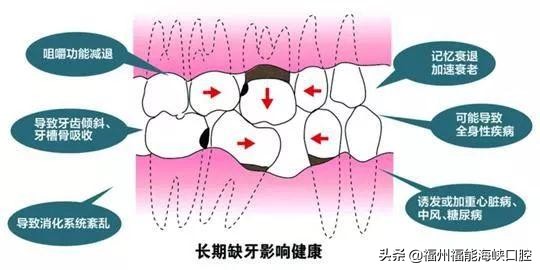 高龄老人真的适合种牙吗？牙医说出实情