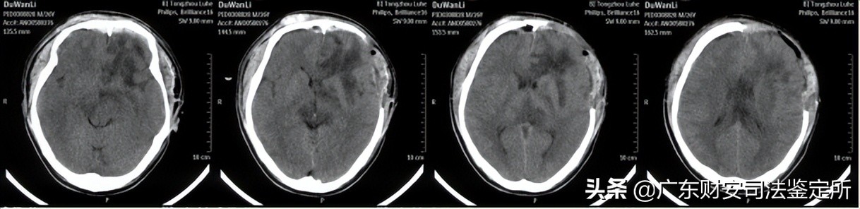 司法鉴定所对高坠伤致头面部损伤的法医临床鉴定