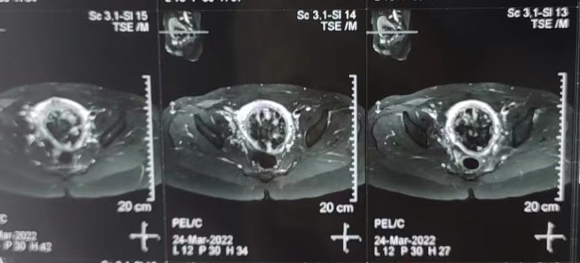 不幸流产或是胎盘植入 高强度超声聚焦技术解决难题