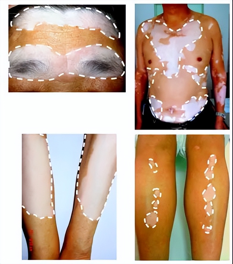 白癜风原创突破背后：一部历时六年的“失败简史”