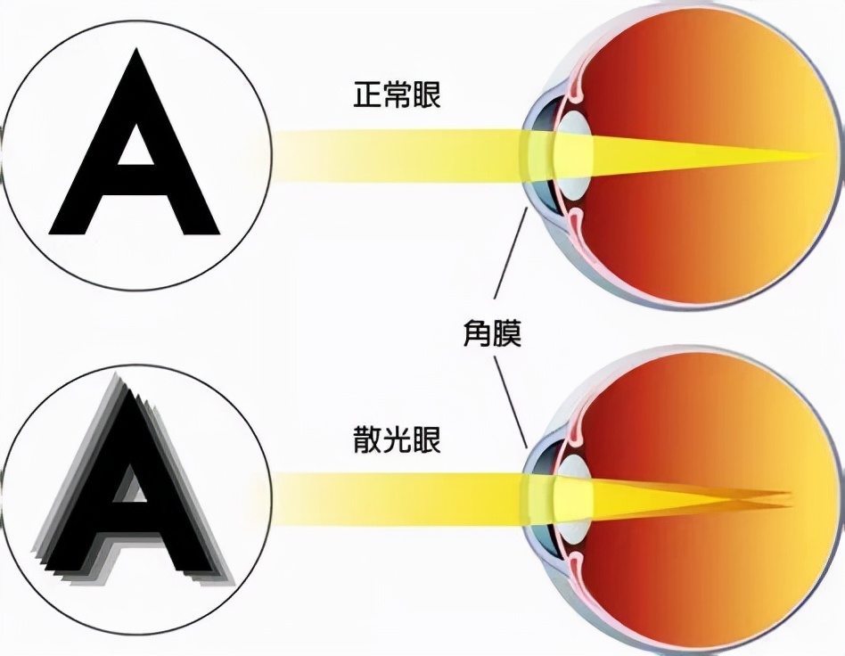 快看看孩子的眼睛！眯眼、流泪、疼痛，很可能隐藏着不可逆的危害