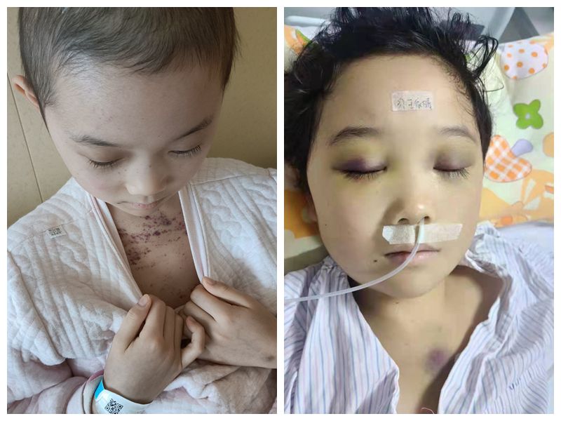 河南9岁女孩患血癌,全身皮肤因出血导致发黑,吃盗版药维持生命