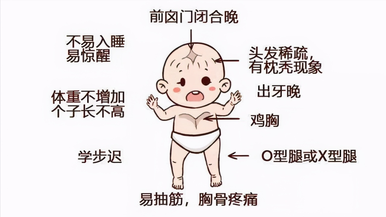 医生提醒:婴幼儿的这些表现,或是佝偻病的征兆!家长注意到了吗