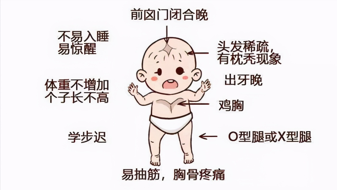 医生提醒：婴幼儿的这些表现，或是佝偻病的征兆！家长注意到了吗