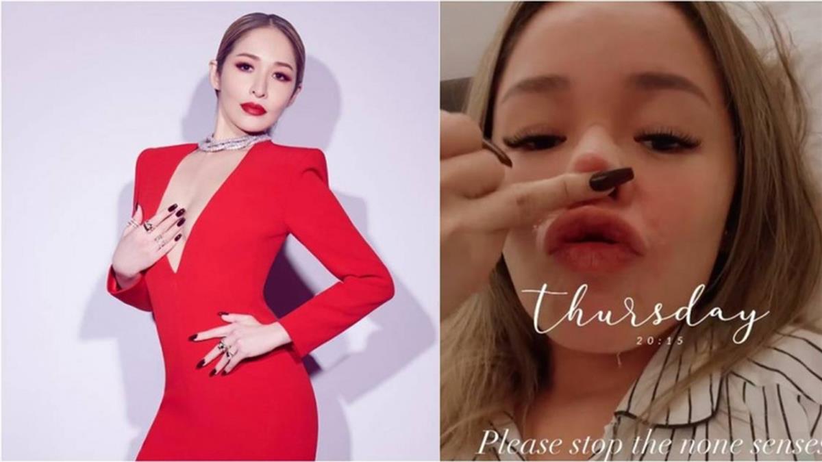 萧亚轩宣告正式复出，脸上被爱犬咬伤的伤疤清晰可见