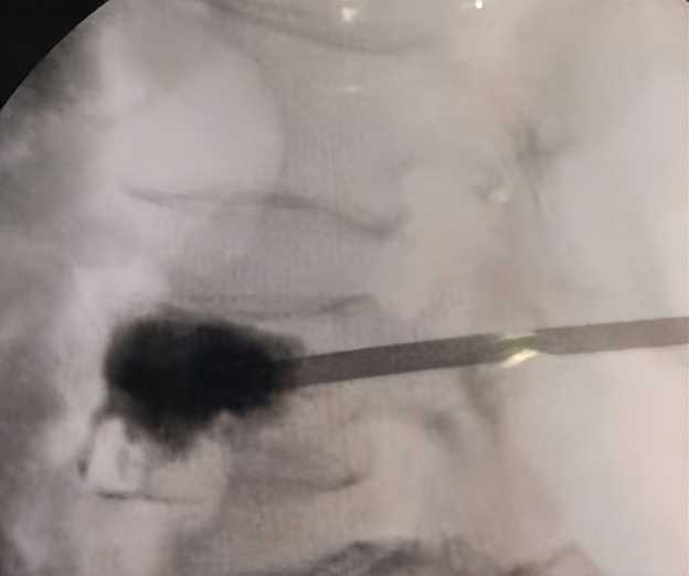 金堂县二医院骨科成功开展县内首例经皮穿刺弯角椎体成形手术