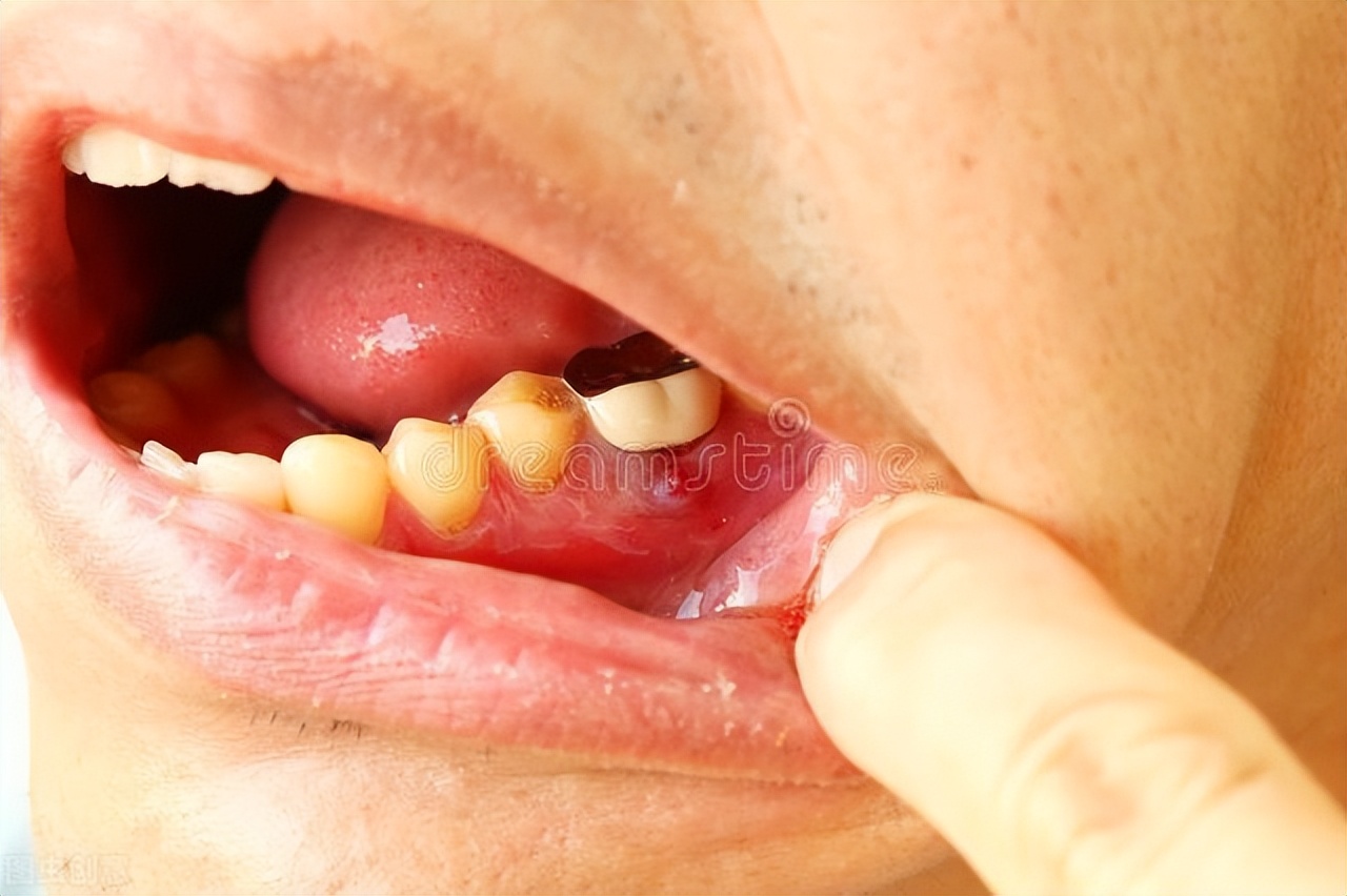 3个症状提醒患有牙周病！提醒：不想掉牙，提前做好3件事