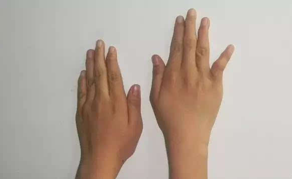 早期肌肉萎缩症图片(手部无力) - 赤虎壹号