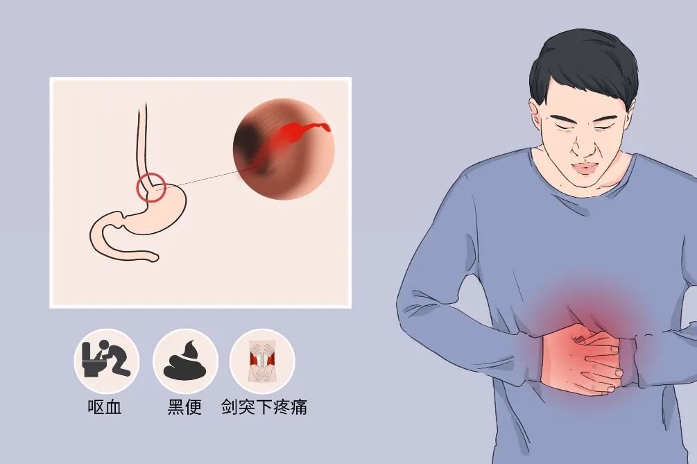 一口气炫一瓶扎啤后，小伙吐血1000毫升