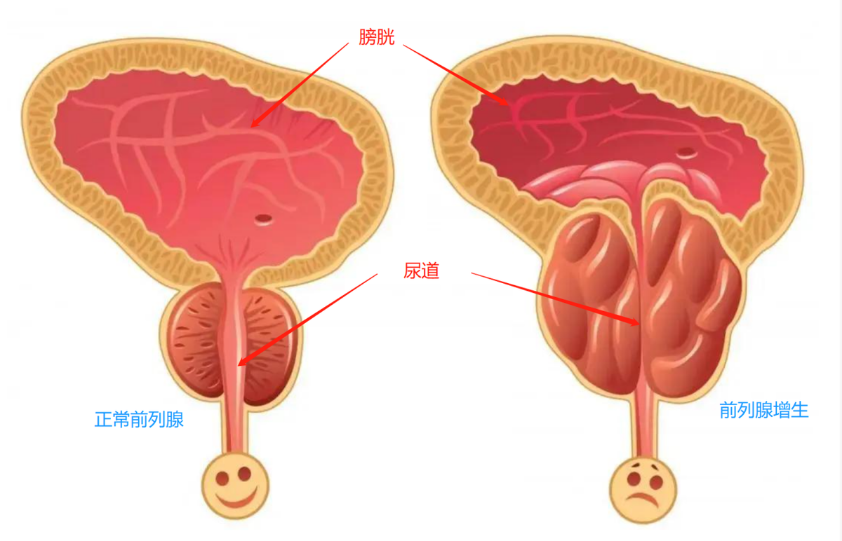 首当其冲就是排尿困难:前列腺紧挨着尿道,尿道连接着膀胱